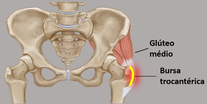 Tendinite do Médio Glúteo vs Trocantendinite